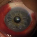 Hyposphagma, Bluterguss im Auge