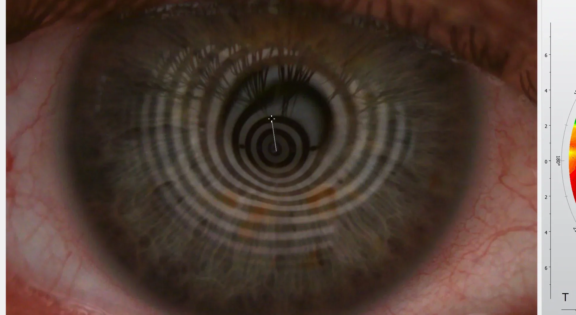 Keratokonus Topographie