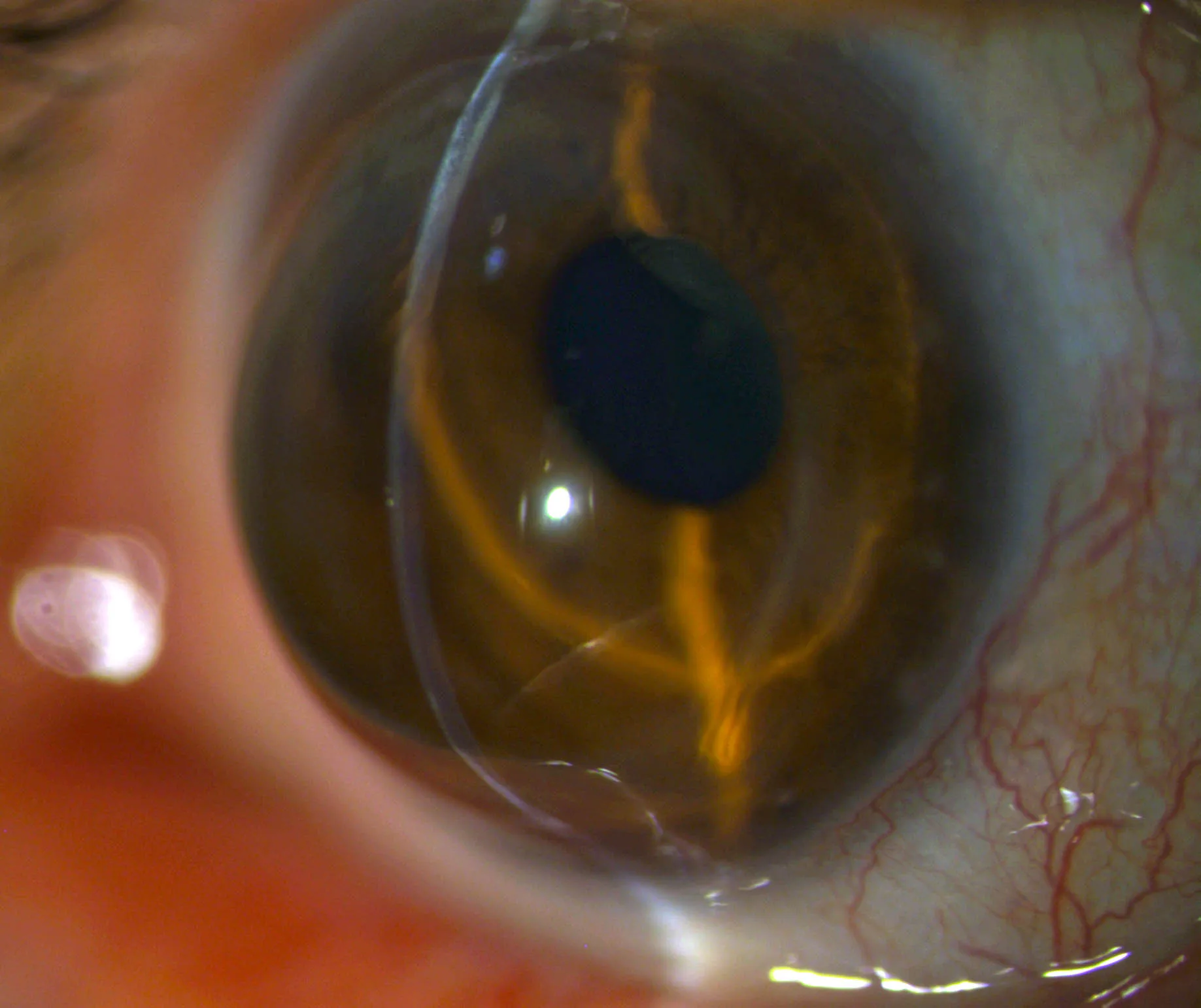 Cornea mit Stufe, PMD. irregulärer Astigmatismus, Hornhauterkrankung