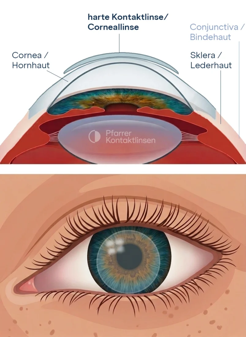 Schematisches Bild Corneallinse