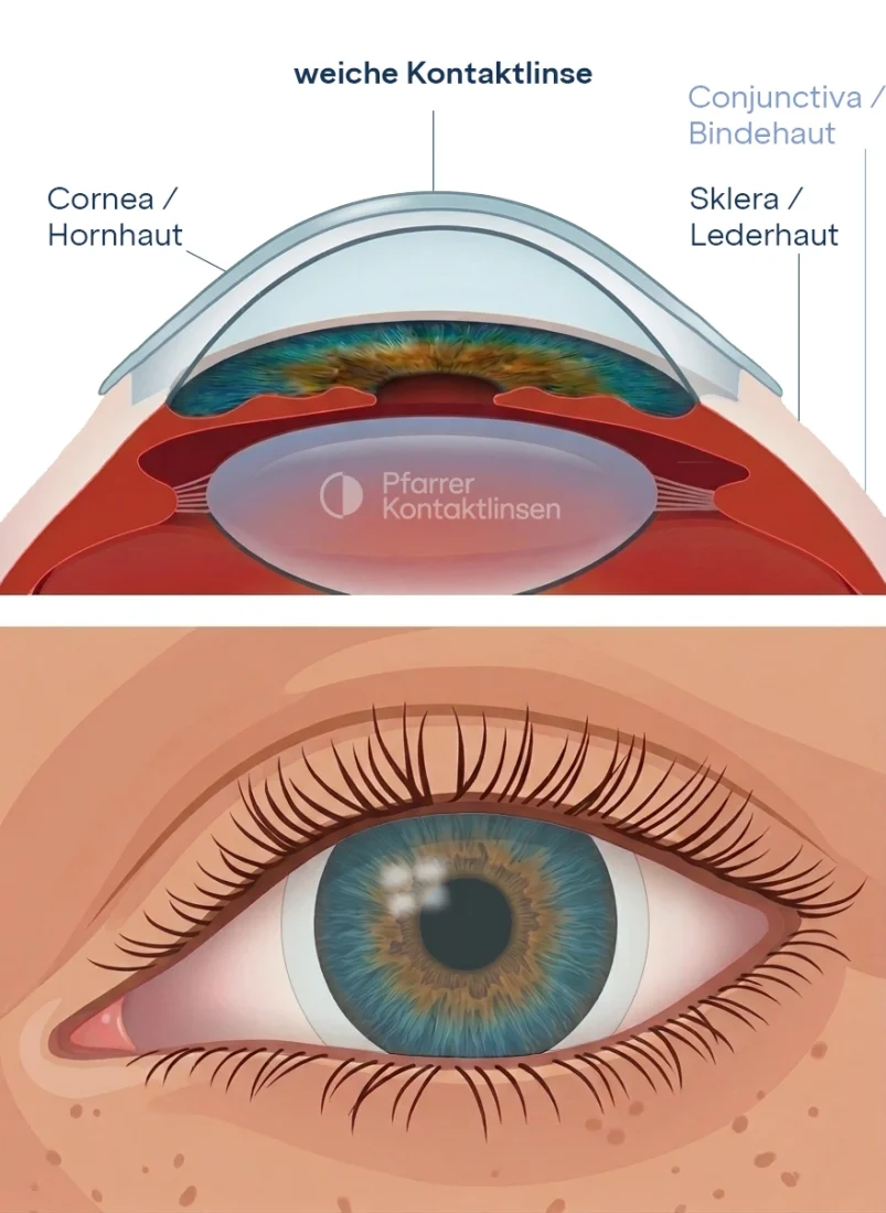 Schematisches Bild weiche Kontaktlinse